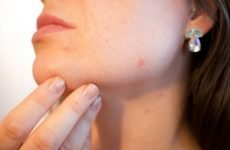 Прищі на шиї і підборідді – причини появи, як і чим лікувати