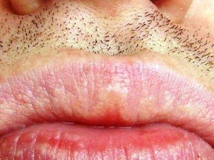 Гранули Фордайса на губах: лікування, симптоми освіти гранул, причини хвороби на обличчі та інших частинах тіла