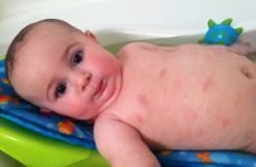 Як відрізнити пітницю від алергії у немовляти. Потничка або алергія у дитини.