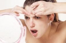 Гормональні прищі у жінок: причини, лікування, як позбавитися від прищів через гормонів на обличчі