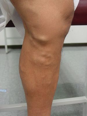 Ущільнення у вигляді кульки під шкірою: шишка на руці під шкірою на запястя, ноги, болить при натисканні