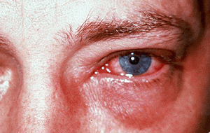 Що робити якщо опік очей після зварювання: методи лікування