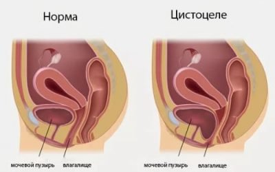 Цистоцеле – що це таке у жінок, симптоми і лікування опущення, випадіння, сечового міхура після видалення матки – операція