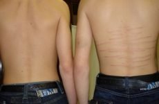 Розтяжки на спині і ногах у підлітка: причини виникнення і лікування стрий, народні методи і процедури