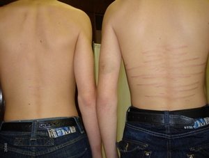 Розтяжки на спині і ногах у підлітка: причини виникнення і лікування стрий, народні методи і процедури