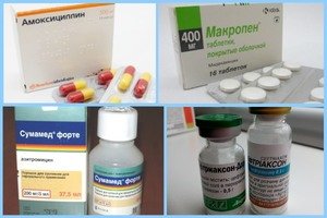 Антибіотики при фурункульозі в паху і на обличчі: тетрацикліни, Цефтріаксон, Амоксиклав і інші препарати