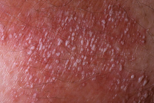 Туберкульоз шкіри: причини та шляхи зараження, симптоми, діагностика