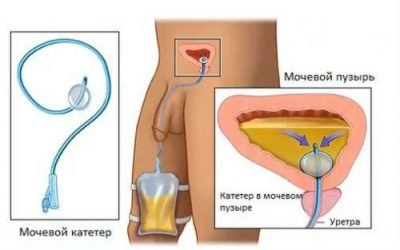 Сечовідний Катетер – для чого вводять в нирку