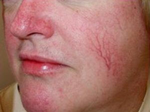 Причини і лікування куперозу на обличчі, аптечні та косметичні засоби проти судинної зірочки