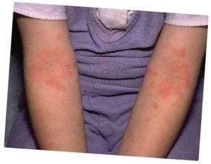 Причини і симптоми кропивянки у дорослих, як виглядає і чим лікувати алергічну кропивянку