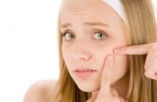 Простудні прищі на обличчі: причини, лікування, як позбавитися від прищів від холоду швидко