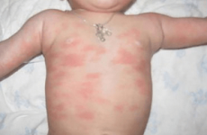 Чим лікувати рожевий лишай у дитини – Комаровський