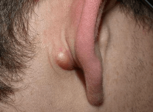 Ліпоми за вухом: методи лікування