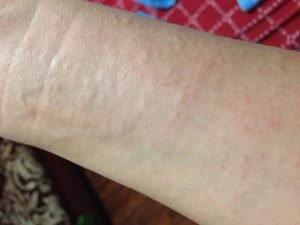 Висип на руках у вигляді червоних плям і крапок: причини появи висипань, лікування і профілактика, відгуки
