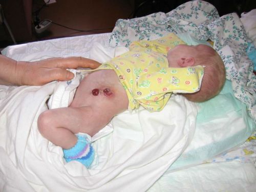 Атрезія прямої кишки, кишечника і 12 палої кишки у новонароджених
