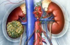 Рак нирки 4 ступеня з метастазами — скільки живуть з пухлиною