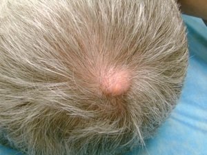 Жировик на голові: як позбутися, причини, симптоми і лікування ліпоми