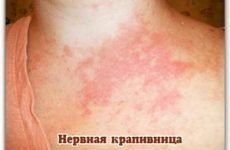 Кропив’янка і алергія на нервовому грунті: причини появи висипу, симптоми і лікування