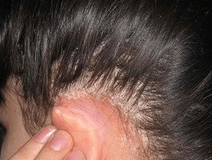 Жирна себорея шкіри голови: методи лікування
