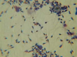 Лейкоцити в спермограмі правила дослідження характеристики стандарт небезпека хвороби лікування