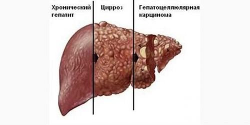 Гепатомегалія печінки: що це за діагноз, як лікувати, причини, ознаки захворювання