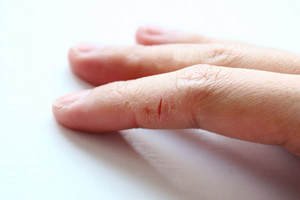 Лікування грибка між пальцями рук медичними і народними засобами; кандидоз та інші види грибка