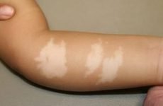 Білі пігментні плями на тілі: причини формування, поява білястих плям на шкірі щік, рук і спини дитини