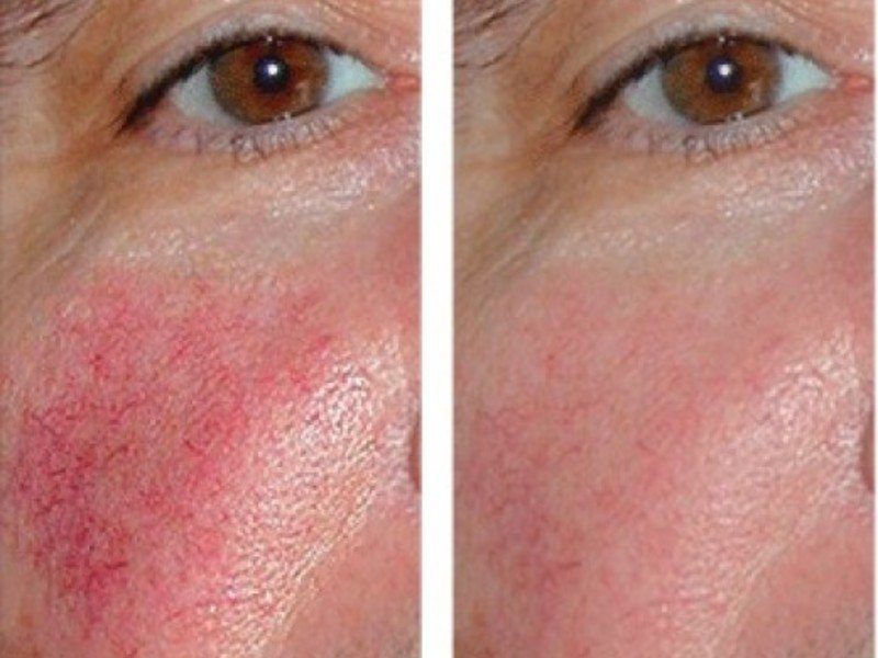 Причини і лікування куперозу на обличчі, аптечні та косметичні засоби проти судинної зірочки