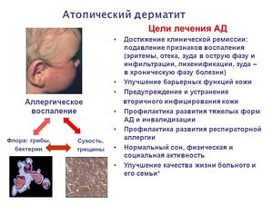 Дитячий атопічний дерматит: причини і симптоми у дитини, лікування алергії у немовляти за Комаровським