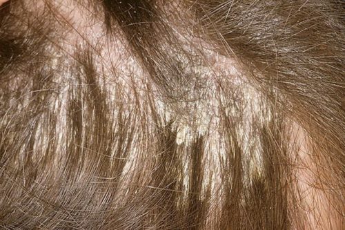 Свербіж шкіри голови: основні причини, лікування, профілактика