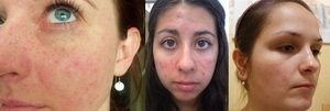 Як прибрати плями від прищів на обличчі: лікувальні мазі та маски, народні методи, косметологічні процедури