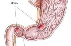 Лікування виразки дванадцятипалої кишки і шлунка