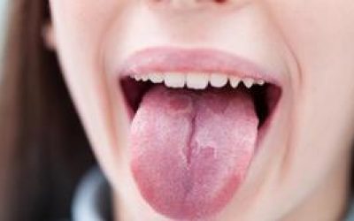 Герпес або застуда на мові: опис захворювання, причини та симптоми, методи лікування дітей і дорослих