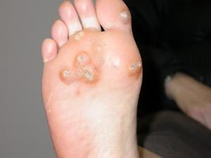 Бородавки на ступнях ніг: опис, причини появи та методи лікування папілом на стопах
