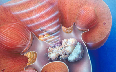 Мікроліти в нирках — що це таке, методи лікування