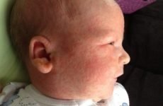Висип у новонароджених: класифікація, лікування, небезпеки