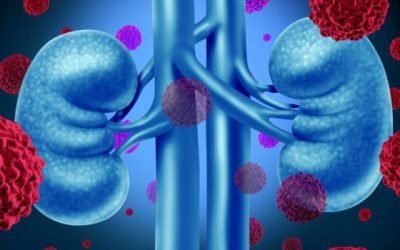 Світлоклітинний рак нирки: прогноз після видалення