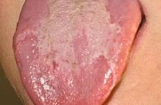 Білий наліт на язиці: причини, лікування