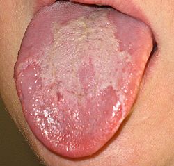 Білий наліт на язиці: причини, лікування