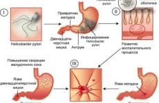 Ознаки виразки шлунка і дванадцятипалої кишки: лікування в домашніх умовах