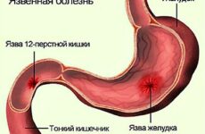 Виразка шлунка: симптоми і лікування у дорослих