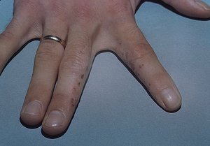 Дисгідрозі кистей рук: симптоматика та причини появи, лікування і профілактика, протипоказання і дієта