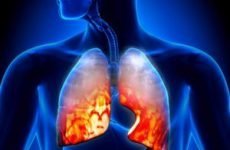 Крупозна пневмонія – це діагноз легенів, його стадії, ускладнення, симптоми, лікування