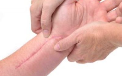 Скільки видів загоєння ран існує: первинне і вторинне натяг, загоєння рани під струпом