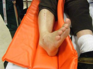 Що робити при вивиху стопи: перша допомога при травмі гомілкостопа, реабілітація ноги