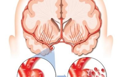 Геморагічний інсульт (крововилив в мозок) головного мозку: діагностика, лікування, причини, симптоми і прогноз одужання