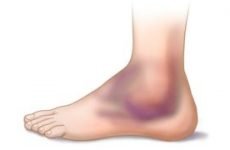 Гематома на нозі після удару: лікування в домашніх умовах, хірургічні методи