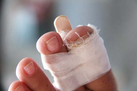 Перелом великого пальця ноги – причини, симптоми, лікування
