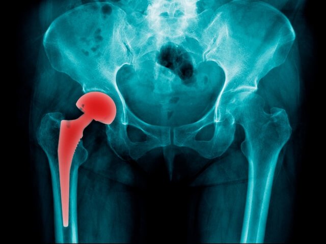 Перелом стегнового суглоба – причини та класифікація отриманої травми, лікування і варіанти реабілітації