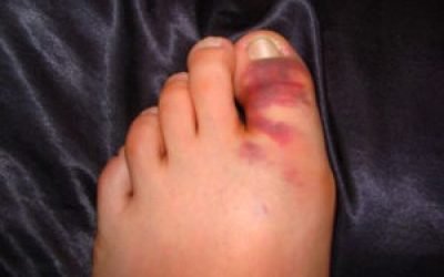 Перелом великого пальця ноги: симптоми і лікування, реабілітація та наслідки
